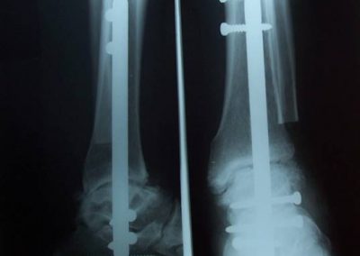 ankle deformity case treated with surgery
