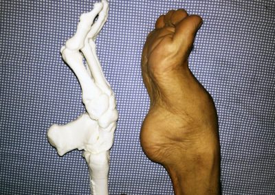 3d printed model of deformity