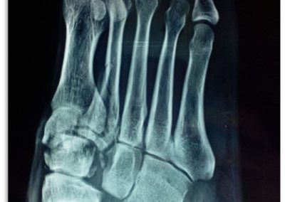 ap foot right side injury