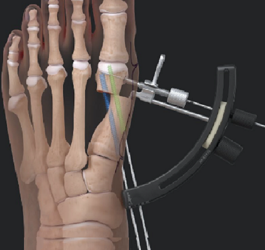 MIS surgery for bunion