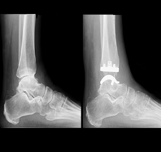 Total ankle replacement 
